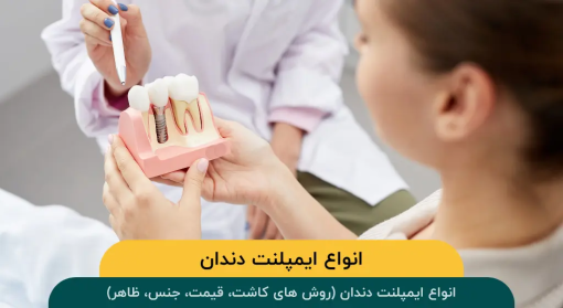 انواع-ایمپلنت-دندان